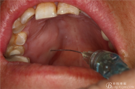 上頜磨牙區(qū)囊腫摘除+根尖切除術(shù) 上頜磨牙區(qū)囊腫摘除+根尖切除術(shù)