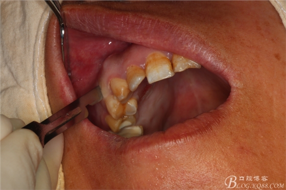 上頜磨牙區(qū)囊腫摘除+根尖切除術(shù) 上頜磨牙區(qū)囊腫摘除+根尖切除術(shù)