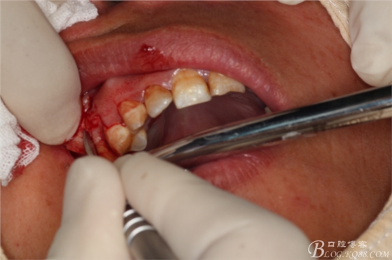 上頜磨牙區(qū)囊腫摘除+根尖切除術(shù) 上頜磨牙區(qū)囊腫摘除+根尖切除術(shù)
