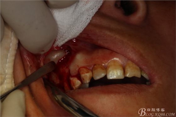 上頜磨牙區(qū)囊腫摘除+根尖切除術(shù) 上頜磨牙區(qū)囊腫摘除+根尖切除術(shù)