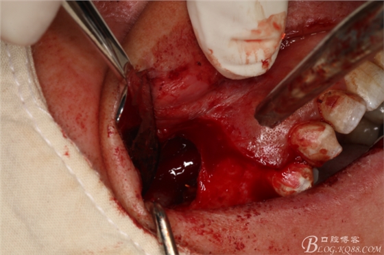 上頜磨牙區(qū)囊腫摘除+根尖切除術(shù) 上頜磨牙區(qū)囊腫摘除+根尖切除術(shù)