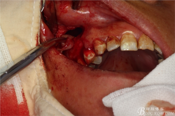 上頜磨牙區(qū)囊腫摘除+根尖切除術(shù) 上頜磨牙區(qū)囊腫摘除+根尖切除術(shù)
