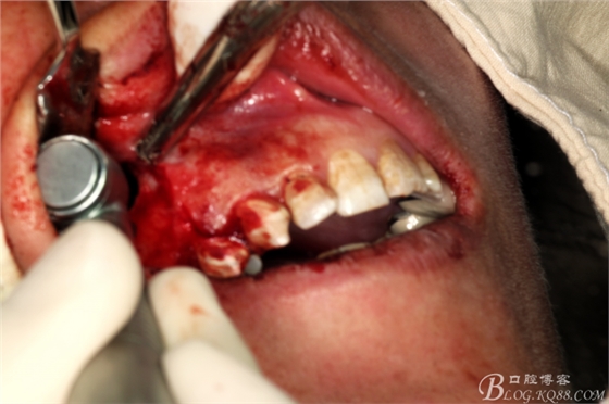 上頜磨牙區(qū)囊腫摘除+根尖切除術(shù) 上頜磨牙區(qū)囊腫摘除+根尖切除術(shù)