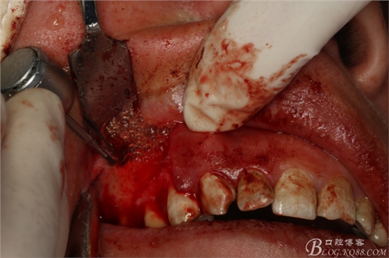 上頜磨牙區(qū)囊腫摘除+根尖切除術(shù) 上頜磨牙區(qū)囊腫摘除+根尖切除術(shù)