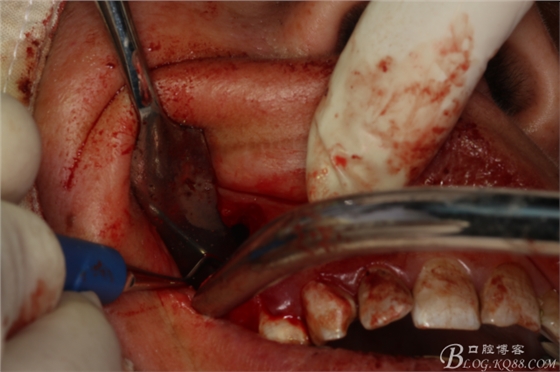 上頜磨牙區(qū)囊腫摘除+根尖切除術(shù) 上頜磨牙區(qū)囊腫摘除+根尖切除術(shù)