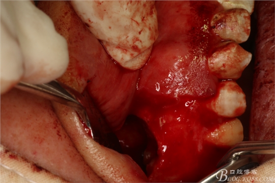 上頜磨牙區(qū)囊腫摘除+根尖切除術(shù) 上頜磨牙區(qū)囊腫摘除+根尖切除術(shù)