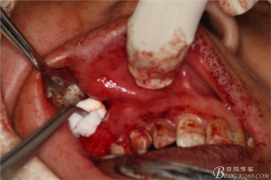 上頜磨牙區(qū)囊腫摘除+根尖切除術(shù) 上頜磨牙區(qū)囊腫摘除+根尖切除術(shù)