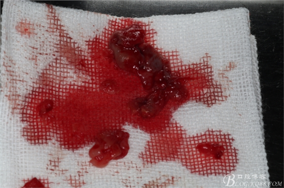 上頜磨牙區(qū)囊腫摘除+根尖切除術(shù) 上頜磨牙區(qū)囊腫摘除+根尖切除術(shù)