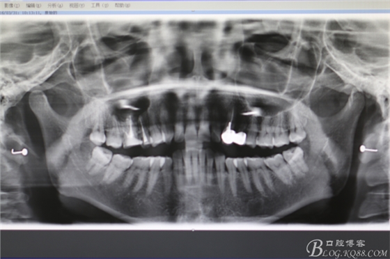 上頜磨牙區(qū)囊腫摘除+根尖切除術(shù) 上頜磨牙區(qū)囊腫摘除+根尖切除術(shù)