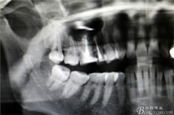 上頜磨牙區(qū)囊腫摘除+根尖切除術(shù) 上頜磨牙區(qū)囊腫摘除+根尖切除術(shù)