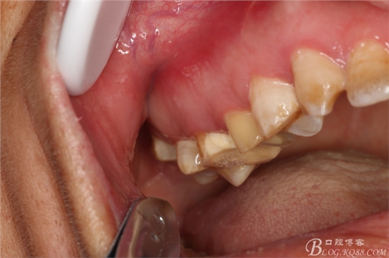 上頜磨牙區(qū)囊腫摘除+根尖切除術(shù) 上頜磨牙區(qū)囊腫摘除+根尖切除術(shù)