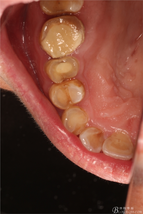 上頜磨牙區(qū)囊腫摘除+根尖切除術(shù) 上頜磨牙區(qū)囊腫摘除+根尖切除術(shù)