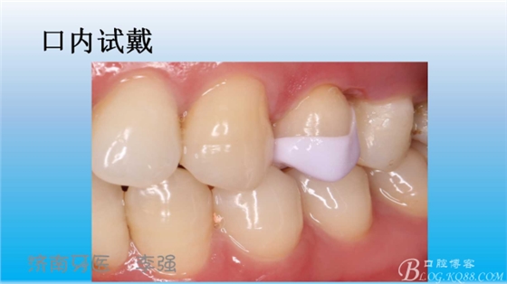 根管再治療，高嵌體即可修復(fù)（濟南牙醫(yī)~ 李強）
