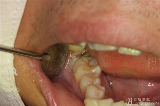 雙側(cè)下頜第二磨牙阻生牙的微創(chuàng)拔除 雙側(cè)下頜第二磨牙阻生牙的微創(chuàng)拔除