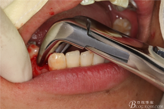 雙側(cè)下頜第二磨牙阻生牙的微創(chuàng)拔除 雙側(cè)下頜第二磨牙阻生牙的微創(chuàng)拔除
