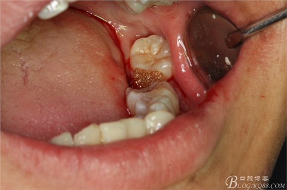 雙側(cè)下頜第二磨牙阻生牙的微創(chuàng)拔除 雙側(cè)下頜第二磨牙阻生牙的微創(chuàng)拔除
