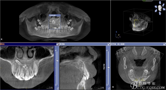 雙切口拔除鼻底埋伏多生牙 雙切口拔除鼻底埋伏多生牙