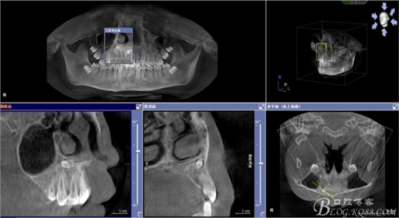 雙切口拔除鼻底埋伏多生牙 雙切口拔除鼻底埋伏多生牙