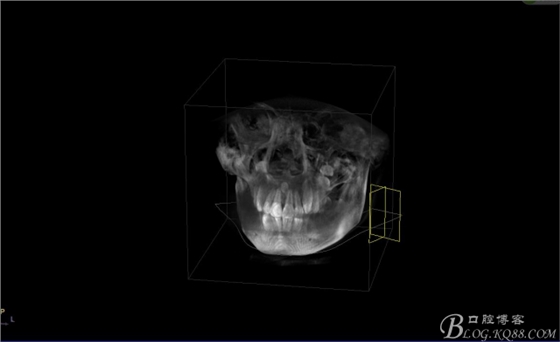 雙切口拔除鼻底埋伏多生牙 雙切口拔除鼻底埋伏多生牙