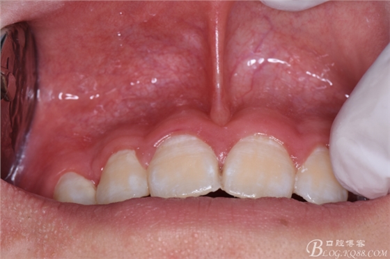 雙切口拔除鼻底埋伏多生牙 雙切口拔除鼻底埋伏多生牙