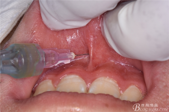 雙切口拔除鼻底埋伏多生牙 雙切口拔除鼻底埋伏多生牙