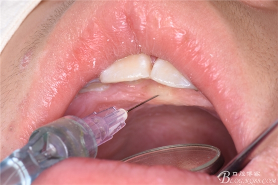 雙切口拔除鼻底埋伏多生牙 雙切口拔除鼻底埋伏多生牙