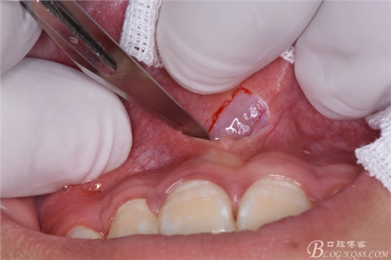 雙切口拔除鼻底埋伏多生牙 雙切口拔除鼻底埋伏多生牙