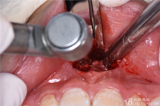 雙切口拔除鼻底埋伏多生牙 雙切口拔除鼻底埋伏多生牙