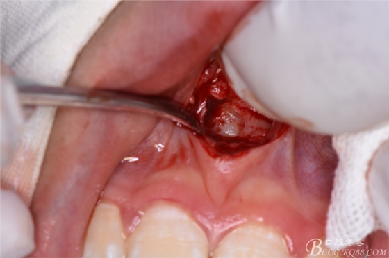 雙切口拔除鼻底埋伏多生牙 雙切口拔除鼻底埋伏多生牙
