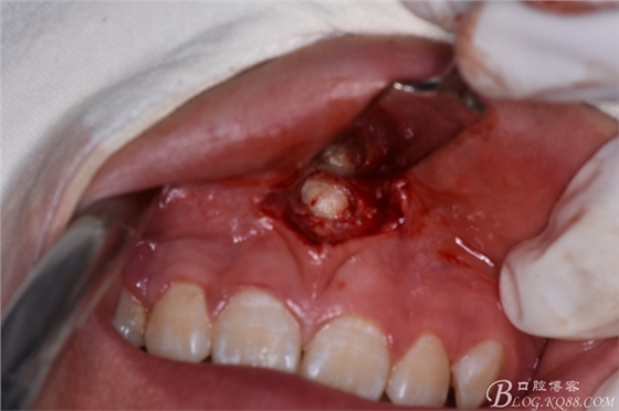 雙切口拔除鼻底埋伏多生牙 雙切口拔除鼻底埋伏多生牙