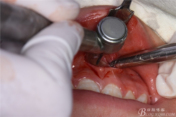 雙切口拔除鼻底埋伏多生牙 雙切口拔除鼻底埋伏多生牙