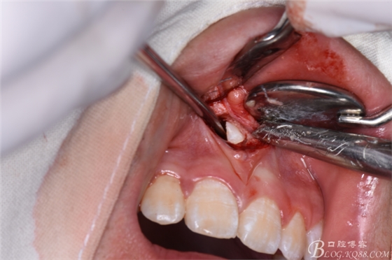 雙切口拔除鼻底埋伏多生牙 雙切口拔除鼻底埋伏多生牙