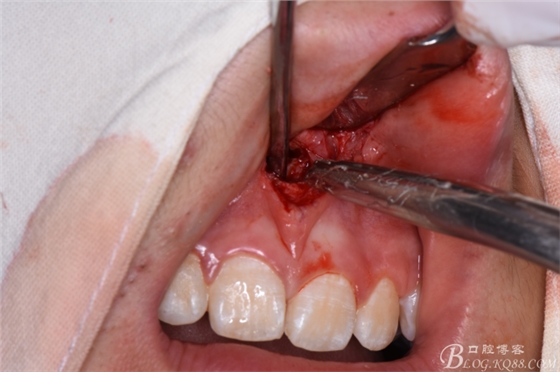雙切口拔除鼻底埋伏多生牙 雙切口拔除鼻底埋伏多生牙