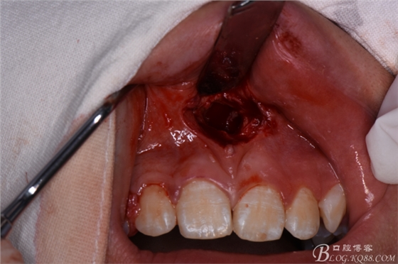 雙切口拔除鼻底埋伏多生牙 雙切口拔除鼻底埋伏多生牙