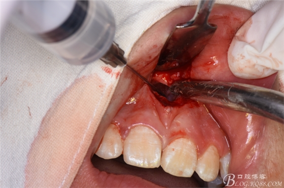 雙切口拔除鼻底埋伏多生牙 雙切口拔除鼻底埋伏多生牙