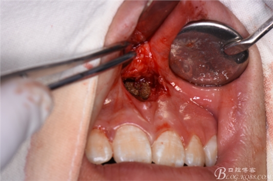雙切口拔除鼻底埋伏多生牙 雙切口拔除鼻底埋伏多生牙