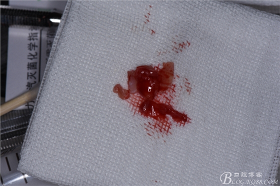 雙切口拔除鼻底埋伏多生牙 雙切口拔除鼻底埋伏多生牙