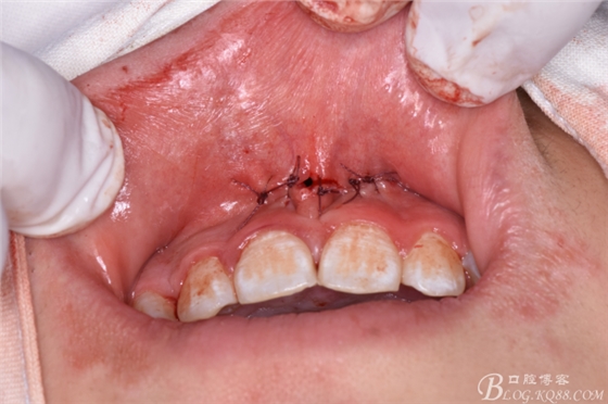 雙切口拔除鼻底埋伏多生牙 雙切口拔除鼻底埋伏多生牙
