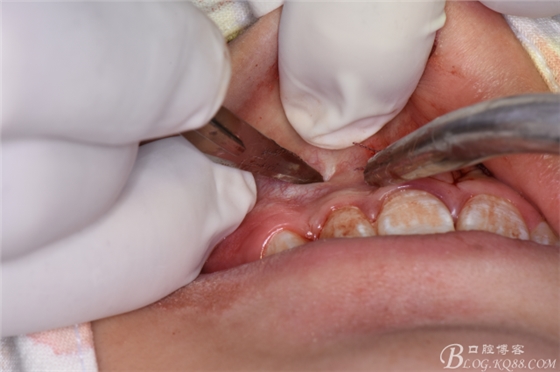 雙切口拔除鼻底埋伏多生牙 雙切口拔除鼻底埋伏多生牙