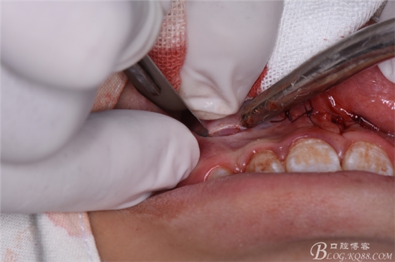 雙切口拔除鼻底埋伏多生牙 雙切口拔除鼻底埋伏多生牙
