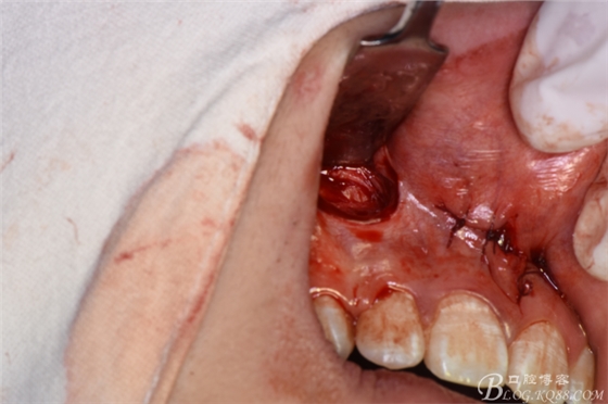 雙切口拔除鼻底埋伏多生牙 雙切口拔除鼻底埋伏多生牙