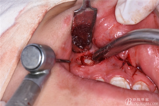 雙切口拔除鼻底埋伏多生牙 雙切口拔除鼻底埋伏多生牙