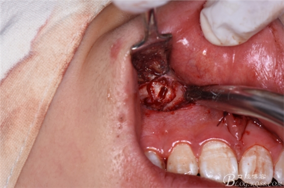 雙切口拔除鼻底埋伏多生牙 雙切口拔除鼻底埋伏多生牙