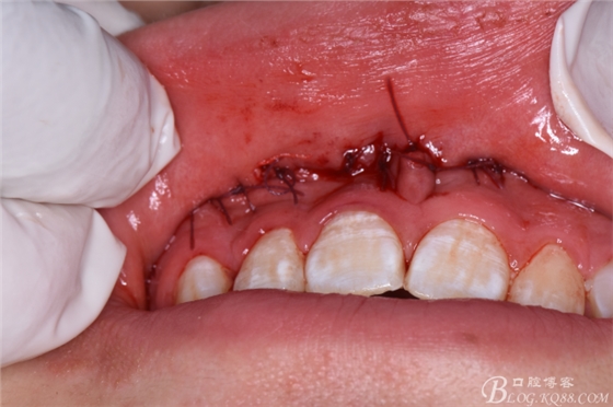 雙切口拔除鼻底埋伏多生牙 雙切口拔除鼻底埋伏多生牙