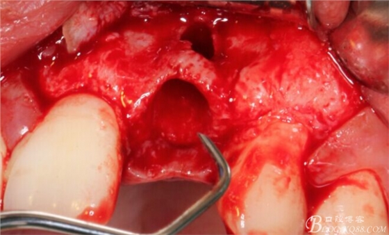 一例上前牙種植失敗病例的補(bǔ)救(梁光強(qiáng)) 一例上前牙種植失敗病例的補(bǔ)救(梁光強(qiáng))