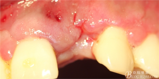 一例上前牙種植失敗病例的補(bǔ)救(梁光強(qiáng)) 一例上前牙種植失敗病例的補(bǔ)救(梁光強(qiáng))