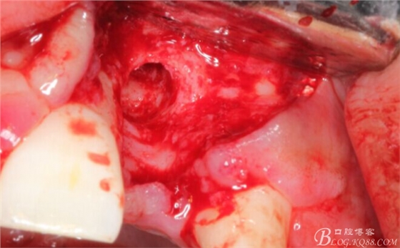 一例上前牙種植失敗病例的補(bǔ)救(梁光強(qiáng)) 一例上前牙種植失敗病例的補(bǔ)救(梁光強(qiáng))