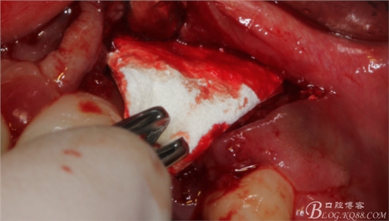 一例上前牙種植失敗病例的補(bǔ)救(梁光強(qiáng)) 一例上前牙種植失敗病例的補(bǔ)救(梁光強(qiáng))