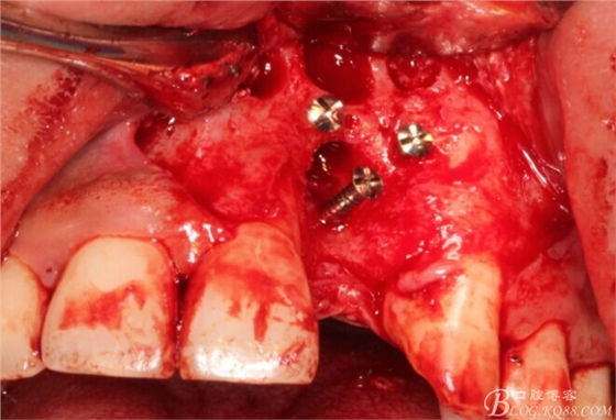 一例上前牙種植失敗病例的補(bǔ)救(梁光強(qiáng)) 一例上前牙種植失敗病例的補(bǔ)救(梁光強(qiáng))