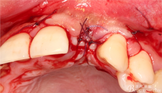一例上前牙種植失敗病例的補(bǔ)救(梁光強(qiáng)) 一例上前牙種植失敗病例的補(bǔ)救(梁光強(qiáng))
